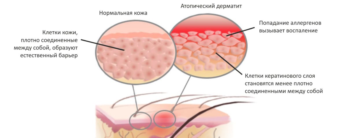 Лечение атопического дерматита ультрафиолетом | Dermalight 311 UVB Дермалайт