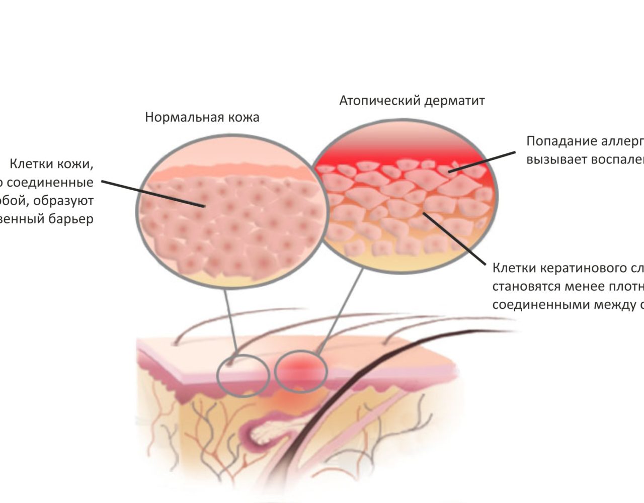 Лечение атопического дерматита